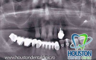 radiografie dentara