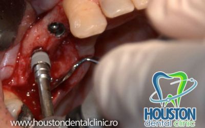 stomatologie implant dentar