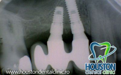 radiografie implant